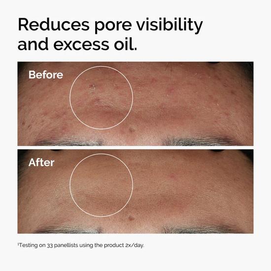 The Ordinary Niacinamide 10% + Zinc 1% 1 oz
